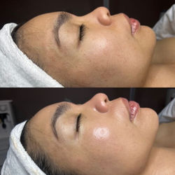 65c061d79c1a33194f882579_65b7f1a5aec46ed9a13100bb_Sig facial before after-p-500