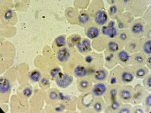 Queensland Health Investigates Two Local Malaria Cases