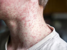 Study warns 1.7 million Australians remain vulnerable to measles