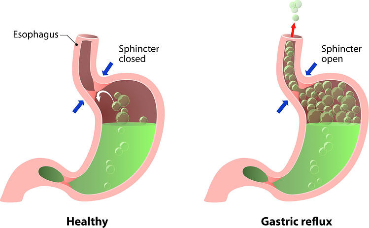 Foto de la anatomía del estómago con el Dr. David Tenembaum, Reflujo ácido, reflujo, gerd, ardor de estómago, dieta de reflujo ácido, medicina de reflujo ácido, síntomas de reflujo ácido, indigestión, symptpoms de acidez estomacal, un top / mejor gastroenterólogo con base en Queens, Jackson Heights, Corona, North Corona, South Corona, Elmhurst, East Elmhurst , Long Island City, Woodside, Sunnyside, Rego Park, Astoria, Astoria Heights, Steinway, Maspeth, Ridgewood, Glendale, College Point, Whitestone, Bayside, Middle Village, Kew Gardens, Richmond Hill, Woodhaven, Ozone Park, Jamaica, Jamaica Estates , Jamaica Hills, Queens Village, Lefrak City, Rosedale, Ravenswood y Forest Hills Nueva York.