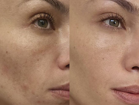 ¿Por qué la piel puede presentar sequedad, inflamación, rojeces, acné, granitos y puntos negros?