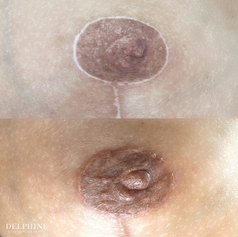 Areola Micropigmentation by Delphine Breyne