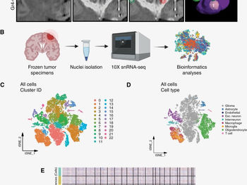 Single-nucleus expression characterization of non-enhancing region of recurrent high-grade glioma
