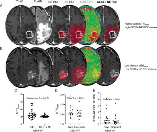 pH-Weighted amine chemical exchange saturation transfer echo planar imaging visualizes infiltrating glioblastoma cells