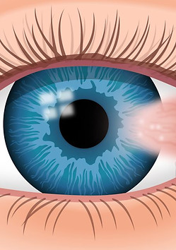 pterygium-1200x630.jpg