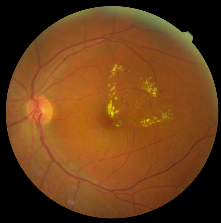Edema Macular Diabético: La principal causa de pérdida visual moderada en personas con diabetes