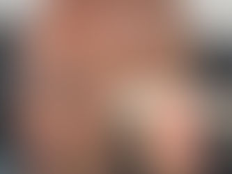 Transform Your Look with Scalp Micropigmentation in Dallas