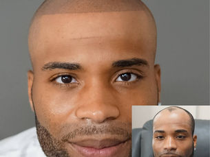 From Bald to Bold: My Transformative Journey with Scalp Micropigmentation