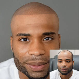 From Bald to Bold: My Transformative Journey with Scalp Micropigmentation