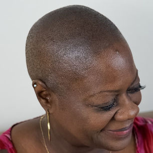 Explore the Top Hair Loss Solutions