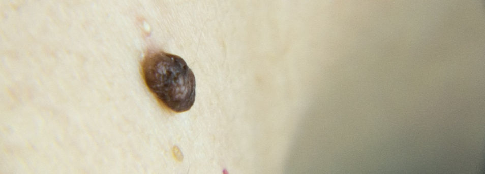 Skin blemish Removal