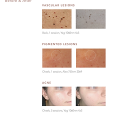 Laser device targeting small visible veins for improved complexion