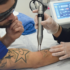 Advanced laser technology used for tattoo removal at Skin Sources in Islington