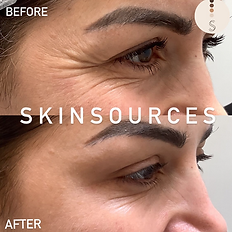 results after eye treatment at Skin sources in Islington