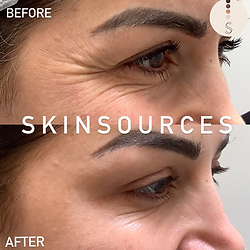 results after eye treatment at Skin sources in Islington