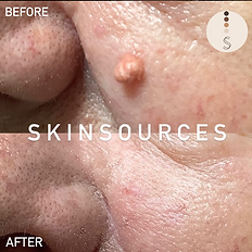 results after a skin blemish removal at Skin sources in Islington