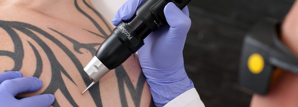 Client receiving professional laser tattoo removal treatment
