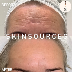 before and after photo of a client who had anti wrinkle injection