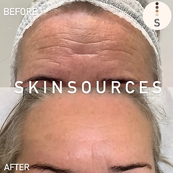 before and after photo of a client who had anti wrinkle injection