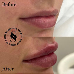 Dermal filler lips
