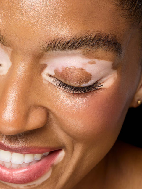 close up of model with vitiligo and glowing skin