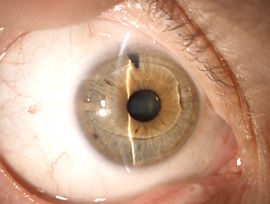 IOL in camera anteriore