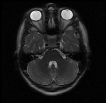 Intravenous tocilizumab in the treatment of resistant optic perineuritis