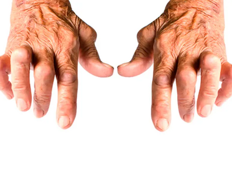 Acupuntura e artrite reumatoide