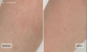 ba-fusion-laser-hair-removal-legs.jpg