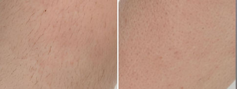 ba-fusion-laser-hair-removal-legs.jpg