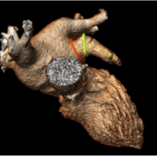 Left Atrial Appendage