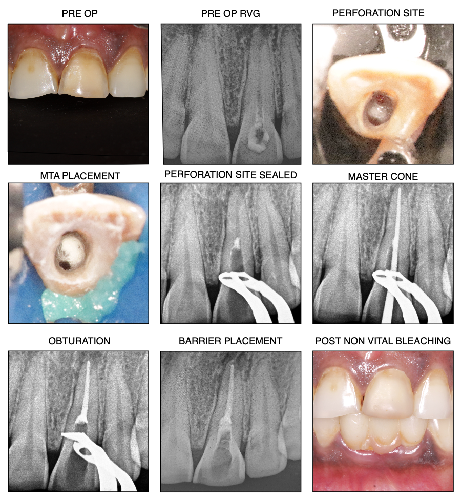 PERFORATION REPAIR