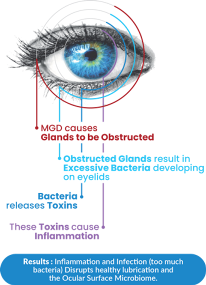 Meibomian Gland Dysfunction affects 90% of dry eye sufferers