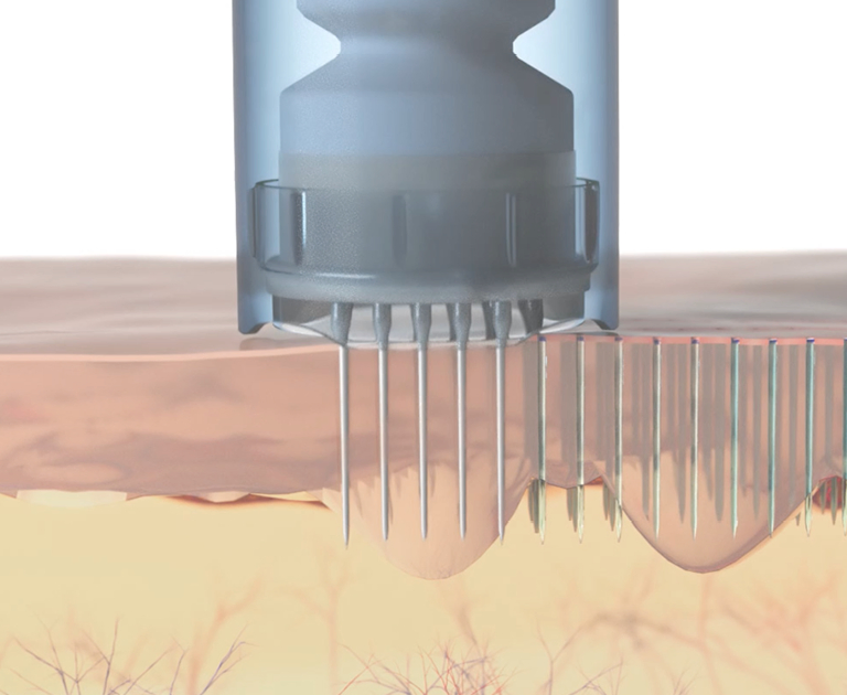 how-does-microneedling-work.webp