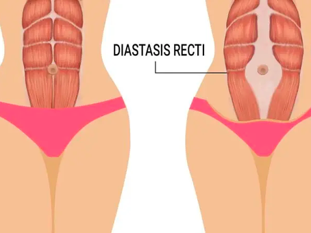 生產後,肚皮還是很大很凸? 有機會是腹直肌分離 !