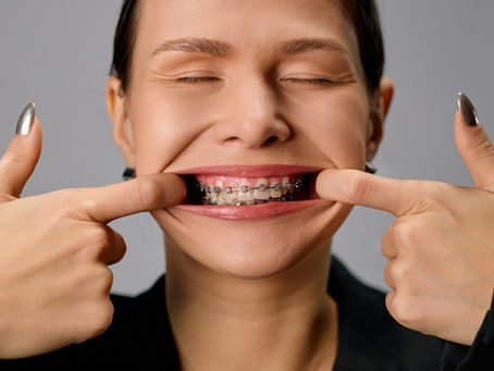 Porque Eu Preciso Corrigir Minha Má Oclusão e Colocar Aparelho? Entenda a Importância do Tratamento Ortodôntico