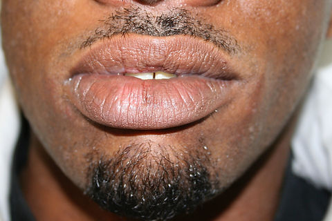 Pigmentation/Lentigo Correction After Treatment
