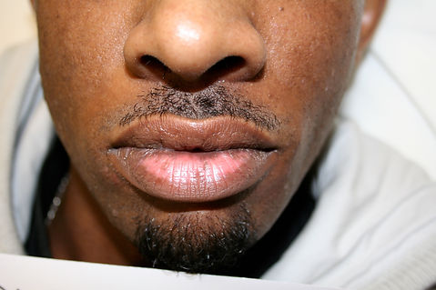 Pigmentation/Lentigo Correction Before Treatment