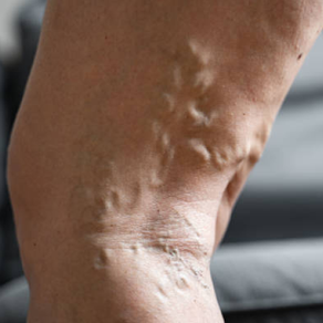 Más Allá del Tratamiento de las Várices