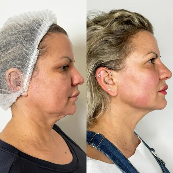 EndoFuze treatment at Urban Angel Aesthetics