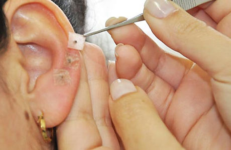 auriculoterapia (1).jpg