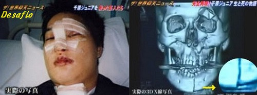 眼球がとび出る大惨事 01年バイク事故 千原ジュニアが瀕死の重傷 鼻が グシャ っと曲がり 眼球がとび出る大惨事 01年バイク事故 千原ジュニアが瀕死の重傷 鼻が グシャ っと曲がり