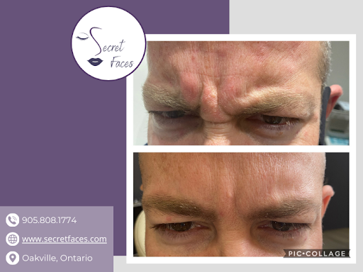 Before and after image of Brotox on a Secret Faces client’s frown lines.