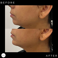 Before and after image of a Prestige Medical Aesthetics client who received Chin Filler treatment.