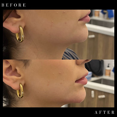 Before and after image of a client who had Jawline Filler treatment at Prestige Medical Aesthetics.