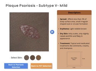 Sample Psoriasis and FST Generated Page