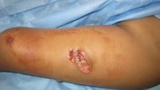 Femur fracture (Thigh bone)