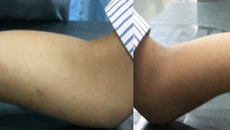 Adolescent Broken forearm!