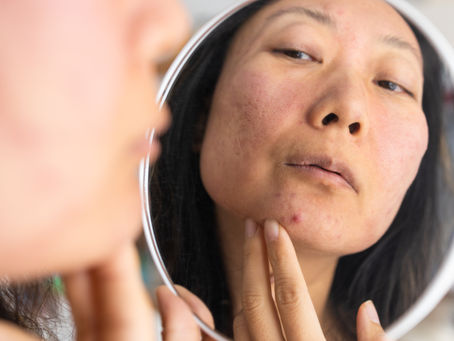 Adult Acne After 30 Why It Happens and Why Your Teenage Solutions Don't Work