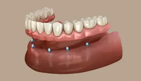 Full Mouth Dental Implants Cost, Procedure, Benefits & Affordable Option
